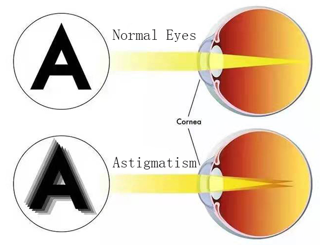 What Is Astigmatism?